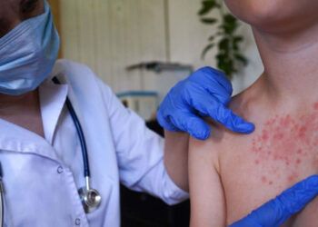 España reporta 101 casos de sarampión en 2026