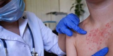 España reporta 101 casos de sarampión en 2026