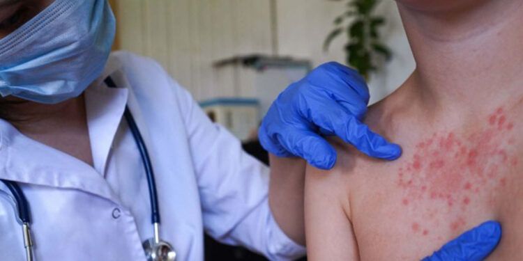 España reporta 101 casos de sarampión en 2026