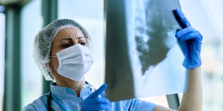 Fibrosis pulmonar idiopática exige diagnóstico temprano