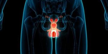 Cáncer de próstata afecta ya a hombres desde los 40 años