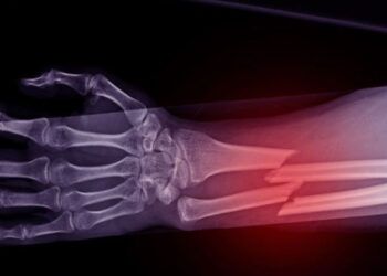 Científicos chinos crean pegamento que repara huesos en 3 minutos