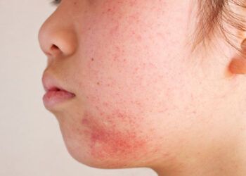Dermatóloga alerta sobre aumento de enfermedades cutáneas por el calor y la humedad