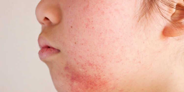 Dermatóloga alerta sobre aumento de enfermedades cutáneas por el calor y la humedad