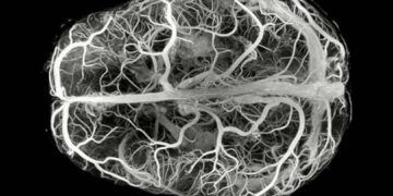 Descubren enfermedad neurológica ultrarrara con solo 13 casos en el mundo
