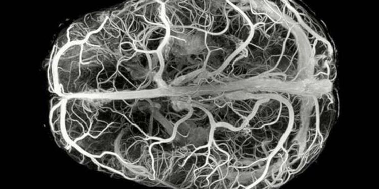 Descubren enfermedad neurológica ultrarrara con solo 13 casos en el mundo