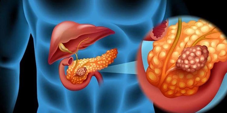 Estudio revela formación de tumor en células del páncreas