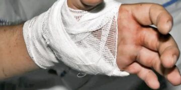 Médicos del Gautier reimplantan nueve manos en lo que va de año