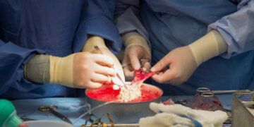 Mujer de Alabama recibe trasplante de riñón de cerdo
