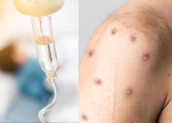 OMS afirma que el brote de mpox puede controlarse y detenerse