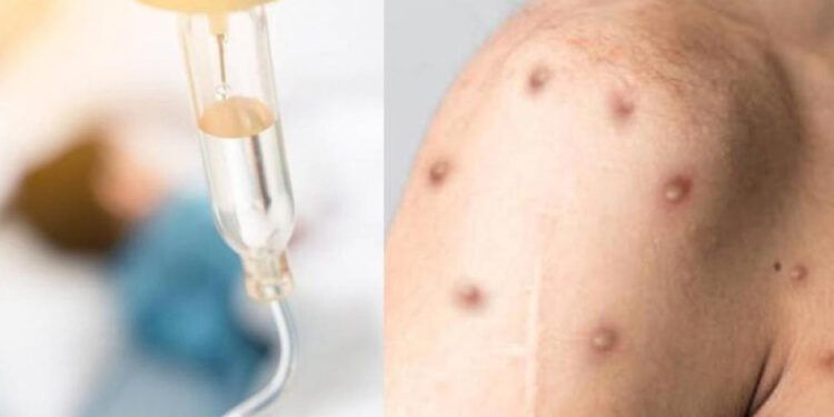 OMS afirma que el brote de mpox puede controlarse y detenerse