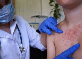 Sociedad Infectología alerta a RD por riesgo de sarampión