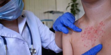 Sociedad Infectología alerta a RD por riesgo de sarampión